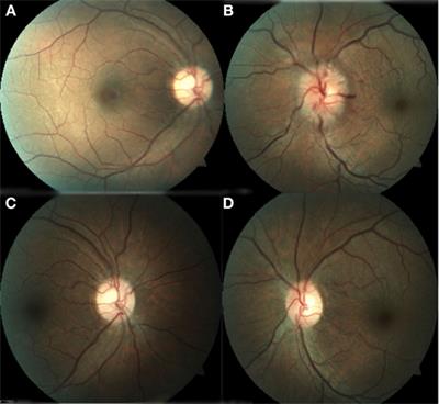 Optic Neuropathy Secondary to Polyarteritis Nodosa, Case Report, and Diagnostic Challenges